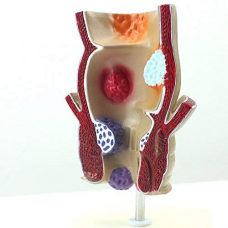 Pathological Model of the Rectum